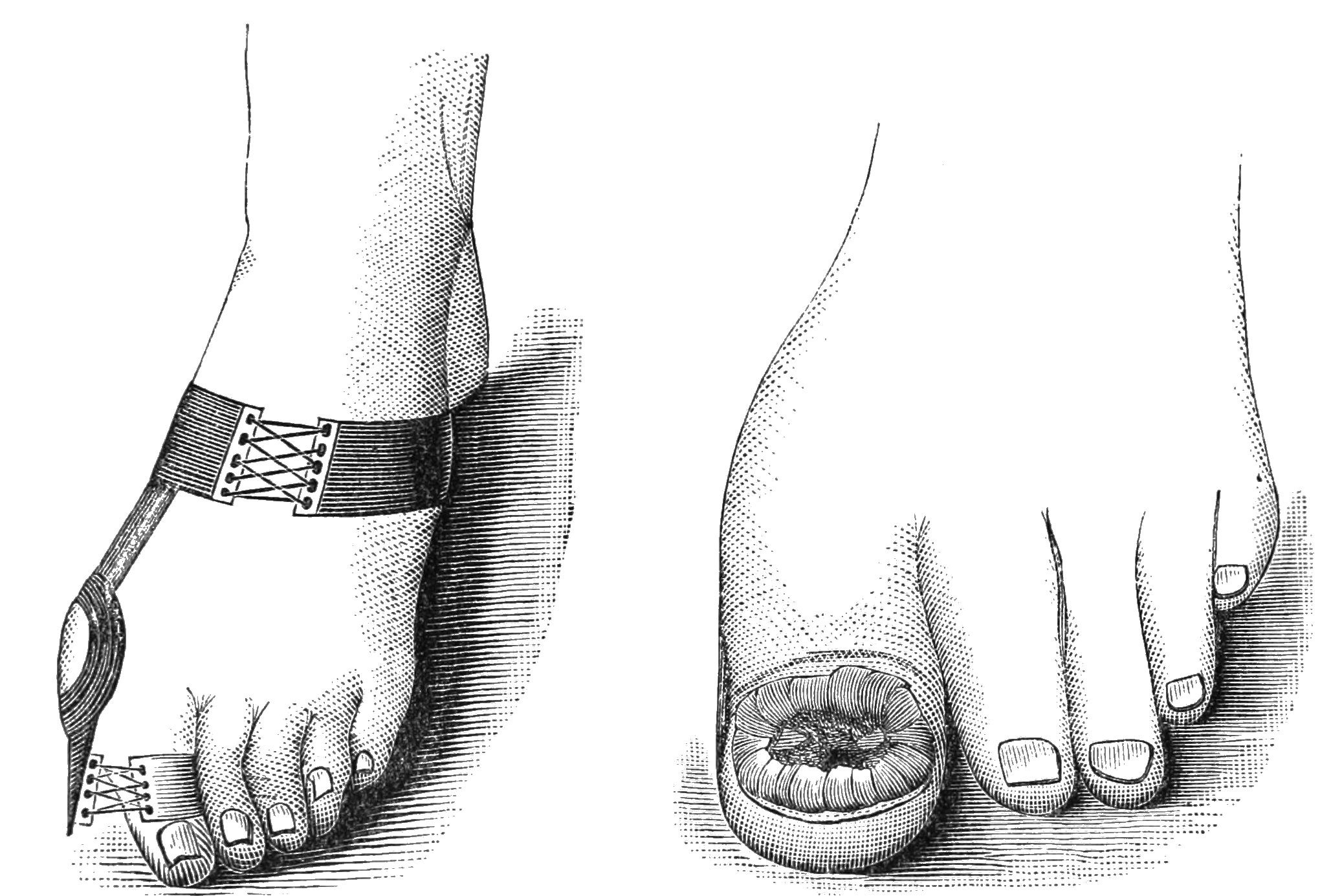 Schwarze und weiße Zeichnung eines Paares Füße, einer mit einem Verband und der andere mit einer Fraktur, mit Text unten, der die Behandlung angibt.