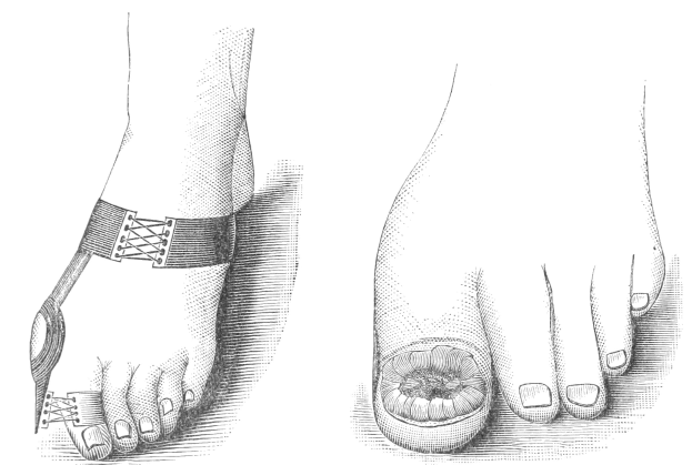 Schwarzes und weißes Bild einer Schuhsohle, eine mit einem Verband und die andere mit einer Fraktur, mit Text, der die Behandlung angibt.